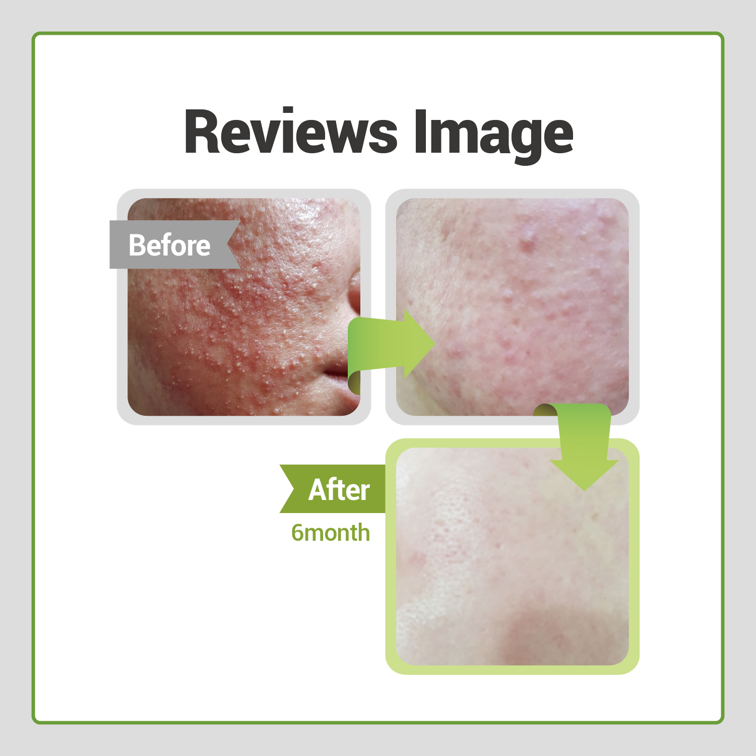 ATOMU Essence Acne Face Serum for Dry or Damaged