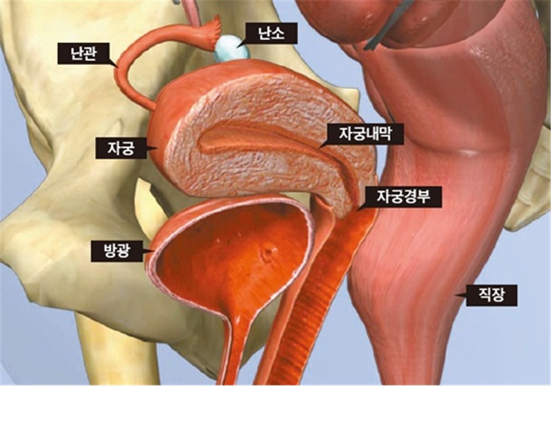 uterine myoma is easily eliminated