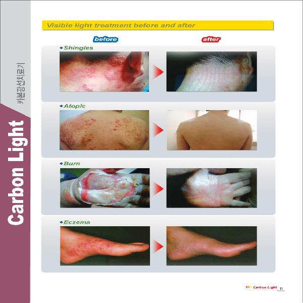 Other than skin diseases atopic dermatitis dry s