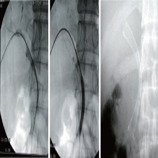 S Biliary Stents Uncovered