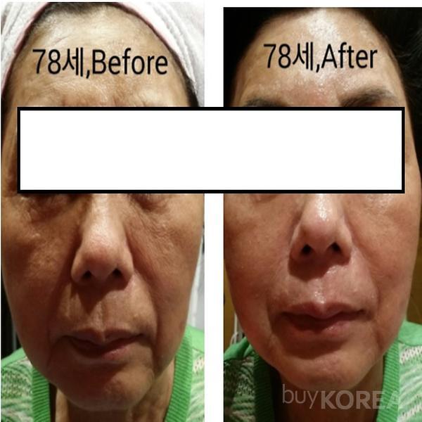 Before & after THESERA L