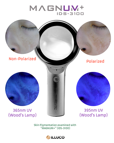 Wood`s Lamp Examination