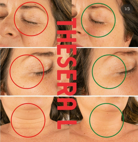 Before & after THESERA L