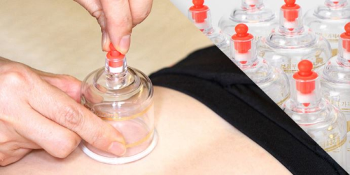 Cupping Set 17 Cups a Set