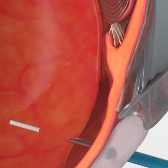 Insertion into vitreous