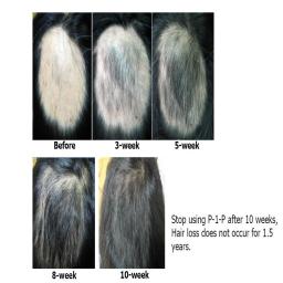 Stop using P-1-P after 10 weeks,
Hair loss does not occur for 1.5 years.