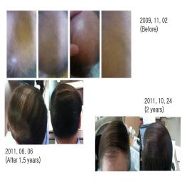 <1> P1P boosts stemcell growth & increases β-Catenin for hair growth
What is P1P? 
As our body ages, s1p in our body that generates new cells lowers its number, and the skin easily wrinkles and cracks.