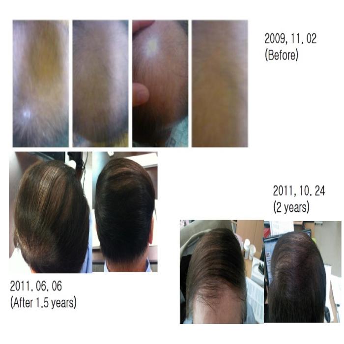 <1> P1P boosts stemcell growth & increases β-Catenin for hair growth
What is P1P? 
As our body ages, s1p in our body that generates new cells lowers its number, and the skin easily wrinkles and cracks.