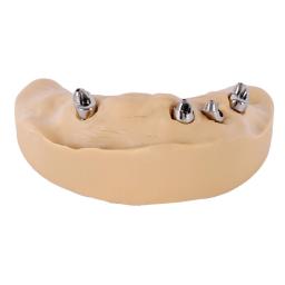 all-on-4 dental implant dentures