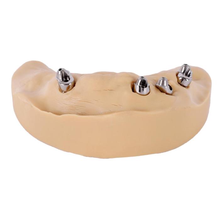 all-on-4 dental implant dentures