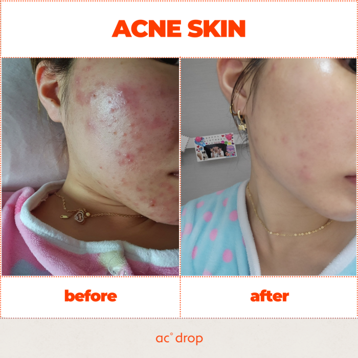 Before & after using. (6 months, adult acne)