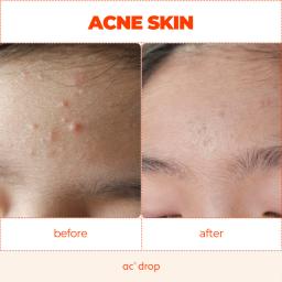 Before & after using. (2 weeks, teen acne)