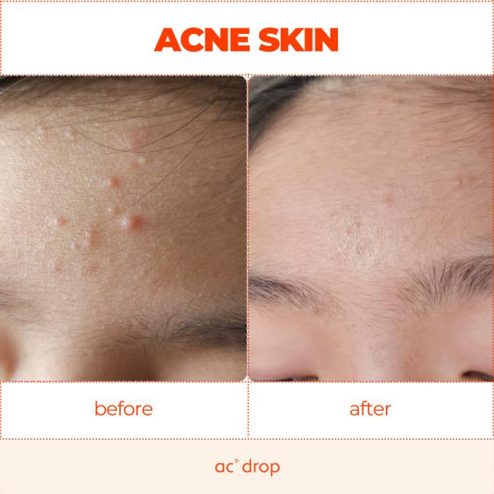 Before & after using. (2 weeks, teen acne)