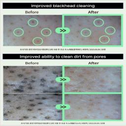Improved blackhead cleaning
&
Improved ability to clean dirt from pores
