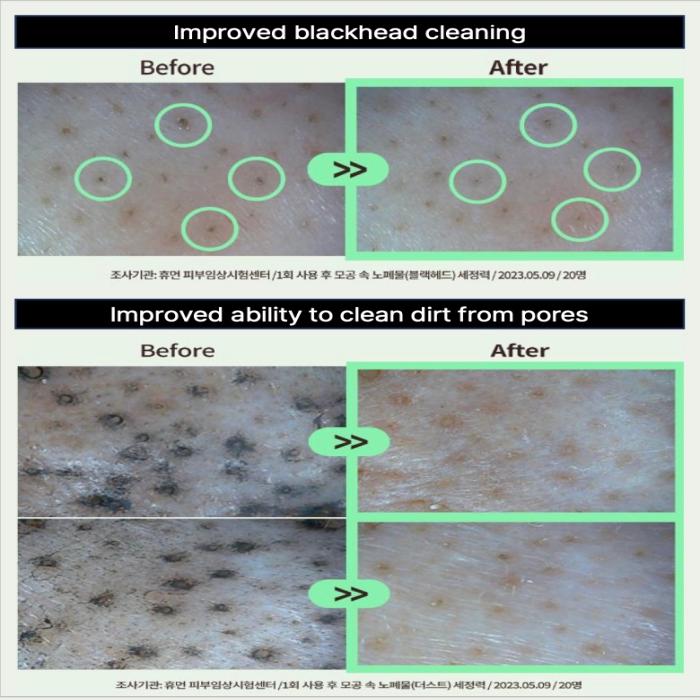 Improved blackhead cleaning
&
Improved ability to clean dirt from pores