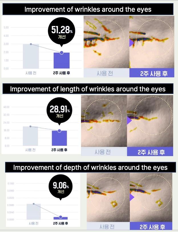 Improvement of wrinkles around the eyes