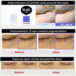 Improvement of eye melanin pigmentation