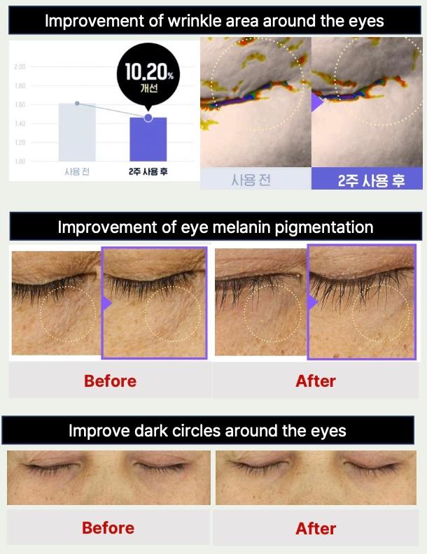 Improvement of eye melanin pigmentation